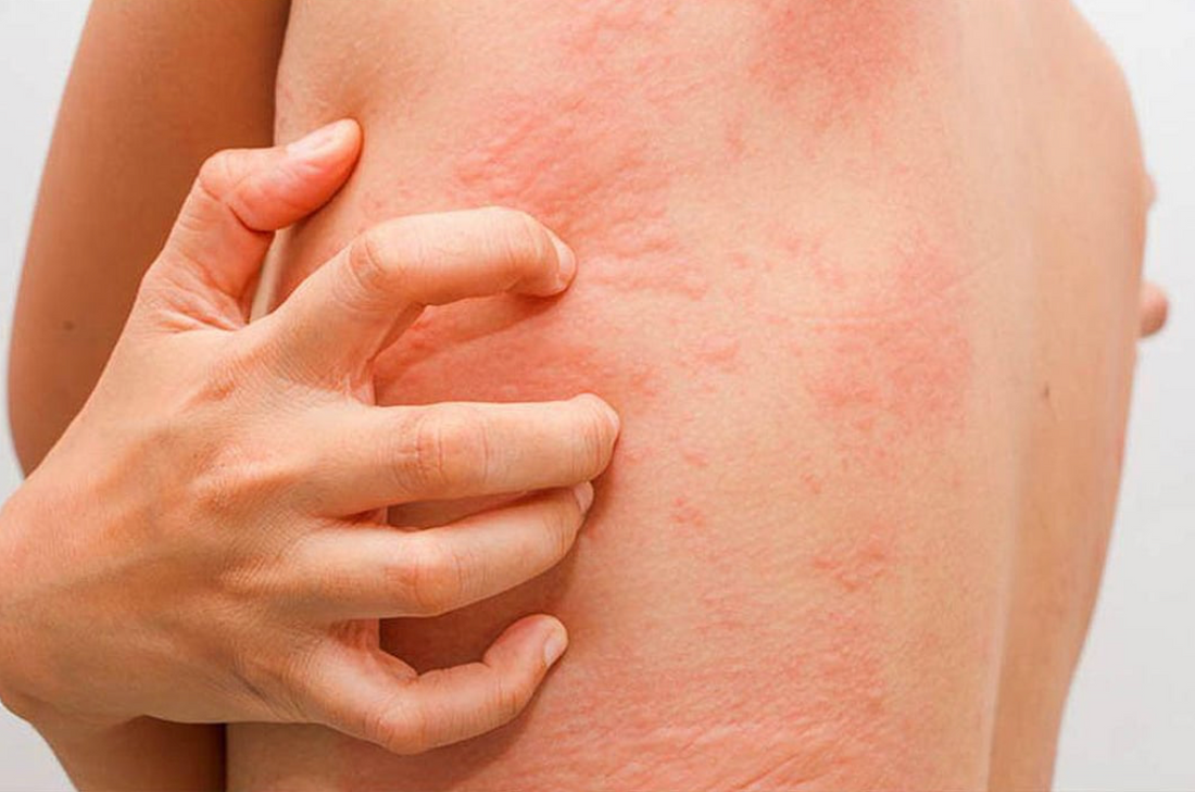 Inflammatory Skin Problems How to Treat Inflammatory Skin Conditions: Inside & Out – Skn From Within